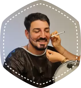 BEARD TRANSPLANT