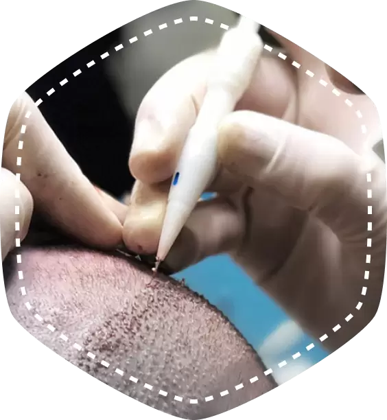 DHI HAIR TRANSPLANT