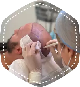 FUE HAIR TRANSPLANT