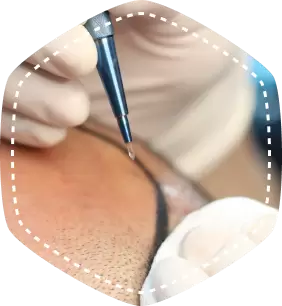SAPPHIRE HAIR TRANSPLANT