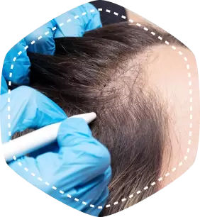 HAIR TRANSPLANT FOR WOMEN